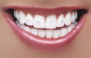 Woman trying on Invisalign clear aligners